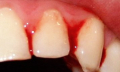 Domácí léčba zánětu dásně
