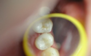 Váček pod zubem léčba