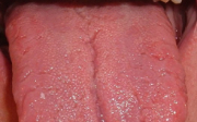 Rakovina na jazyku