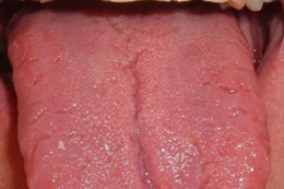Rakovina na jazyku