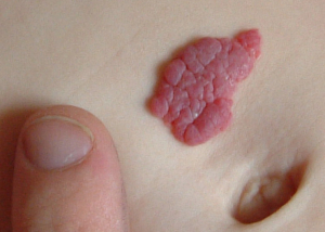 Hemangiomy - nezhoubné kožní nádory