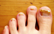 Jak bojovat s plísní nehtů na nohou