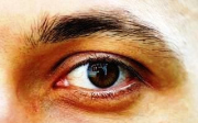 Chronické příznaky syndromu suchého oka