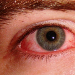 Červené oči nebo pupínky kolem očí